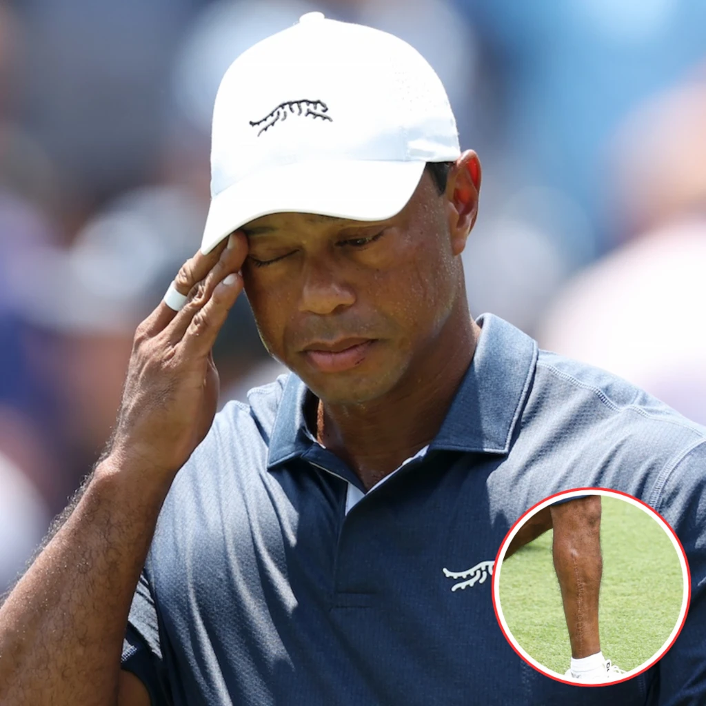 New photos show the extent of Tiger Woods' leg injury is more 'serious